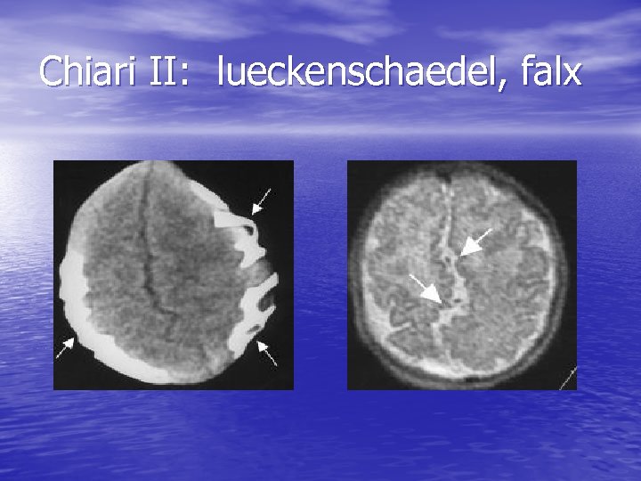Chiari II: lueckenschaedel, falx 
