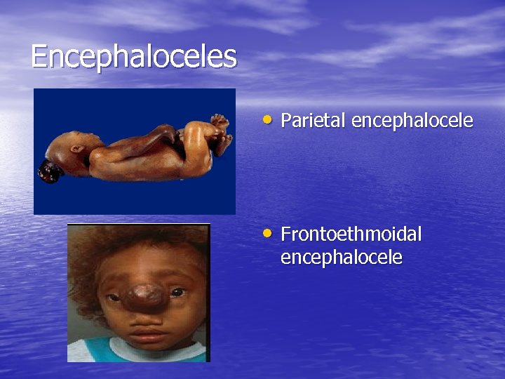 Encephaloceles • Parietal encephalocele • Frontoethmoidal encephalocele 