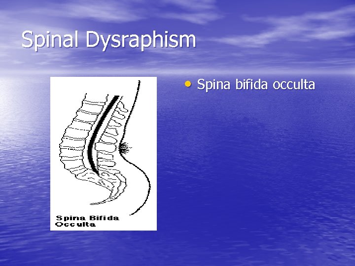 Spinal Dysraphism • Spina bifida occulta 