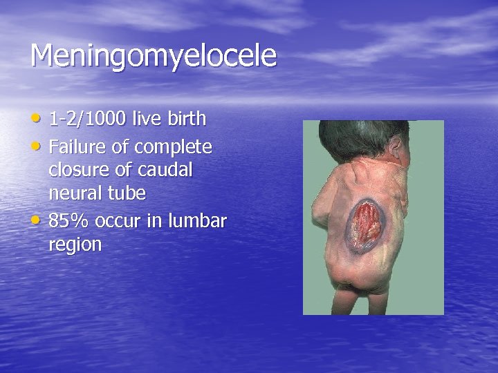 Meningomyelocele • 1 -2/1000 live birth • Failure of complete • closure of caudal