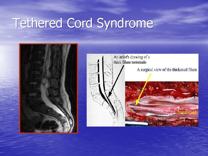 Tethered Cord Syndrome 