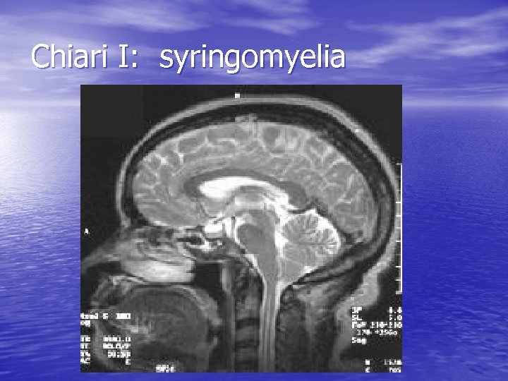 Chiari I: syringomyelia 