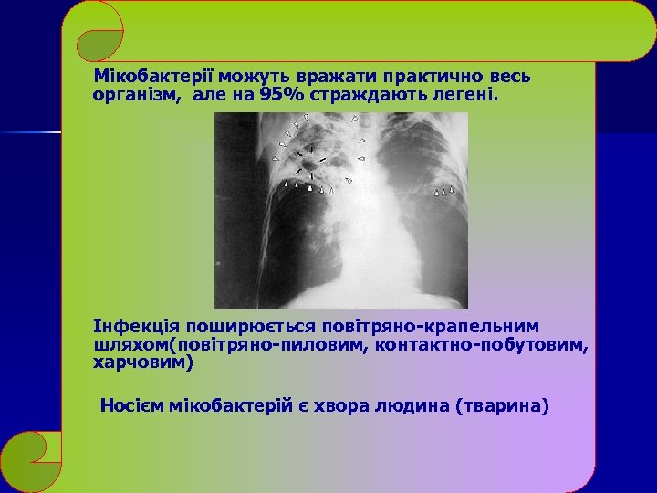 Мікобактерії можуть вражати практично весь організм, але на 95% страждають легені. Інфекція поширюється повітряно-крапельним