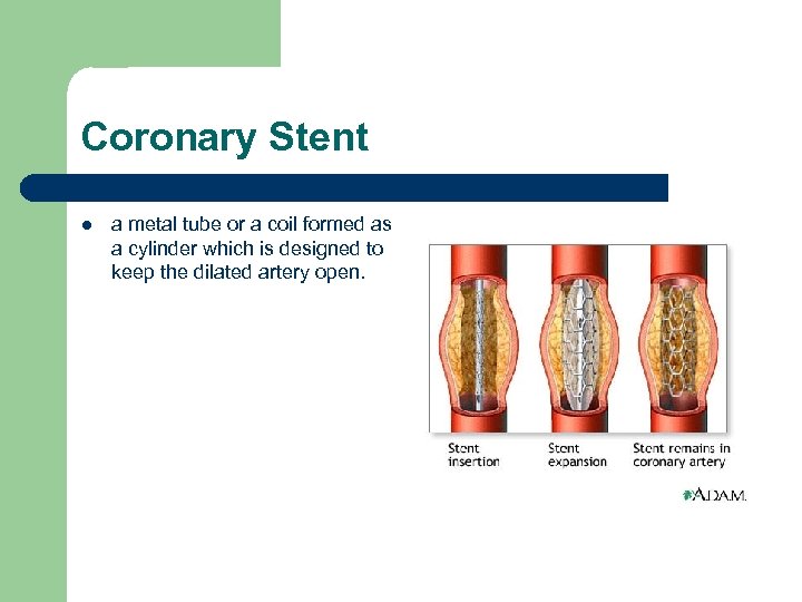 Coronary Stent l a metal tube or a coil formed as a cylinder which