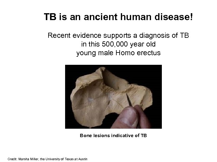 TB is an ancient human disease! Recent evidence supports a diagnosis of TB in
