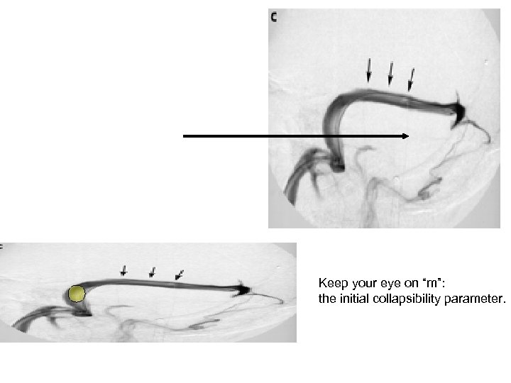 Keep your eye on “m”: the initial collapsibility parameter. 