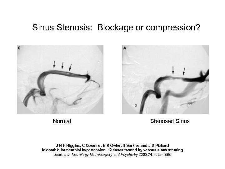 Sinus Stenosis: Blockage or compression? Normal Stenosed Sinus J N P Higgins, C Cousins,