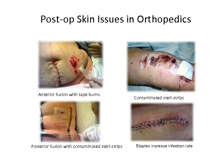 Post‐op Skin Issues in Orthopedics Anterior fusion with tape burns Posterior fusion with contaminated