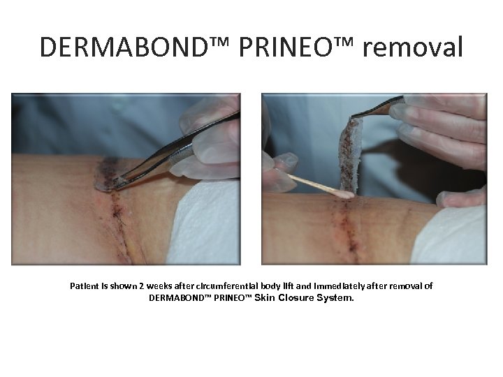 DERMABOND™ PRINEO™ removal Patient is shown 2 weeks after circumferential body lift and immediately