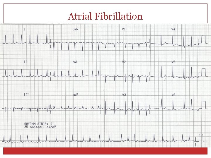 Atrial Fibrillation 