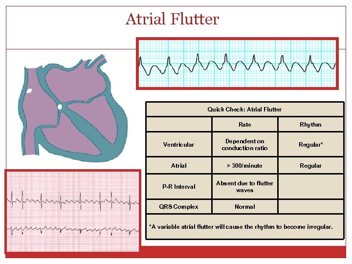 Atrial Flutter Quick Check: Atrial Flutter Rate Rhythm Ventricular Dependent on conduction ratio Regular*