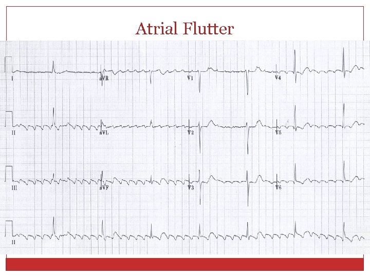 Atrial Flutter 