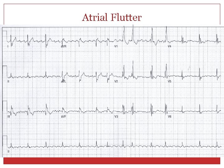 Atrial Flutter 