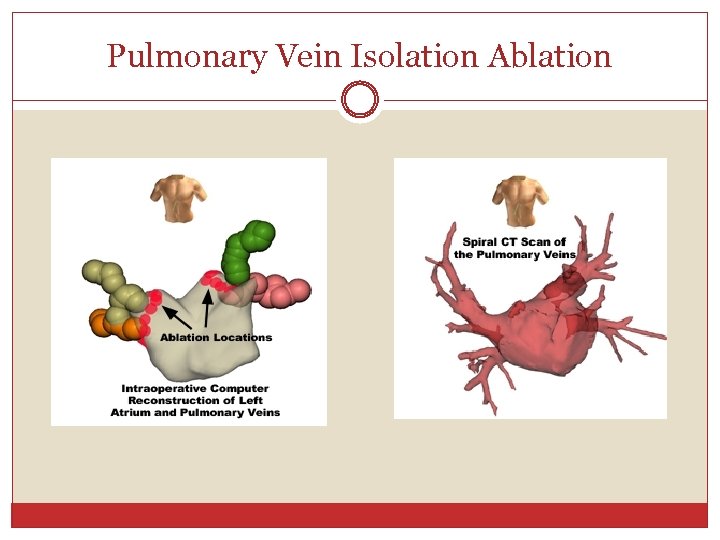 Pulmonary Vein Isolation Ablation 