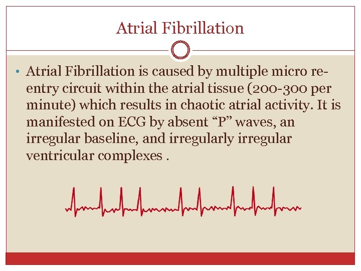 Atrial Fibrillation • Atrial Fibrillation is caused by multiple micro re- entry circuit within