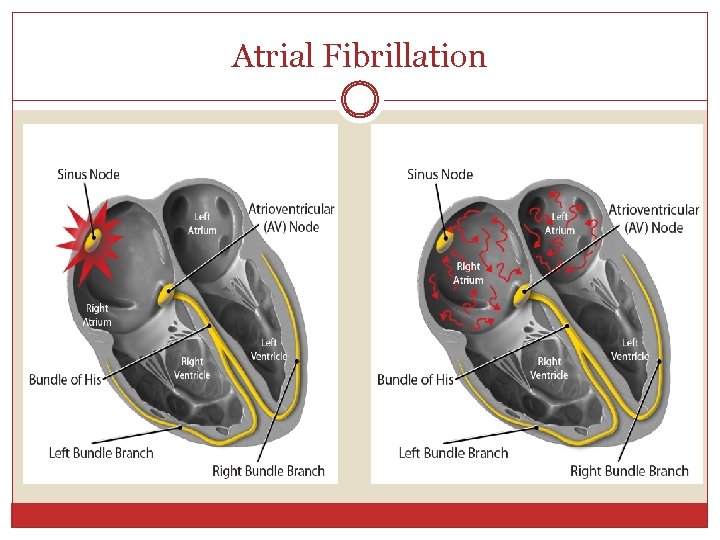 Atrial Fibrillation 