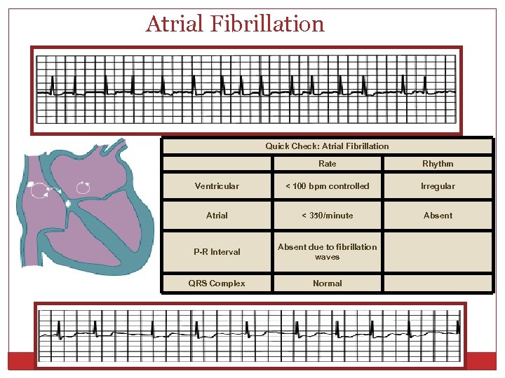 Atrial Fibrillation Quick Check: Atrial Fibrillation Rate Rhythm Ventricular < 100 bpm controlled Irregular