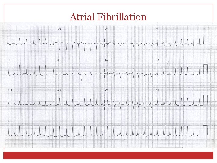 Atrial Fibrillation 