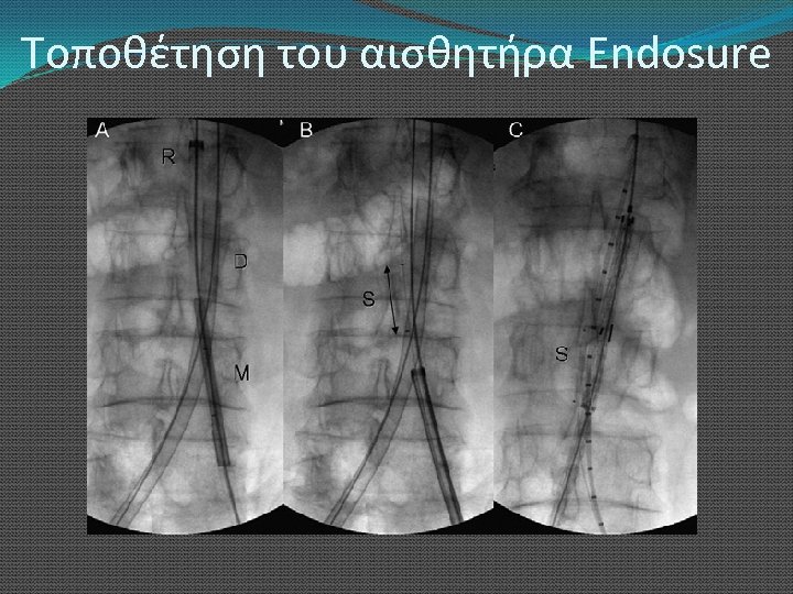 Τοποθέτηση του αισθητήρα Endosure 