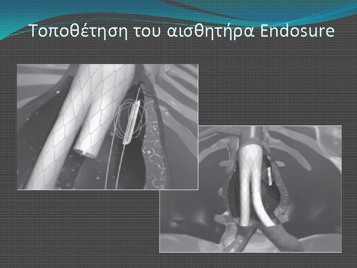 Τοποθέτηση του αισθητήρα Endosure 