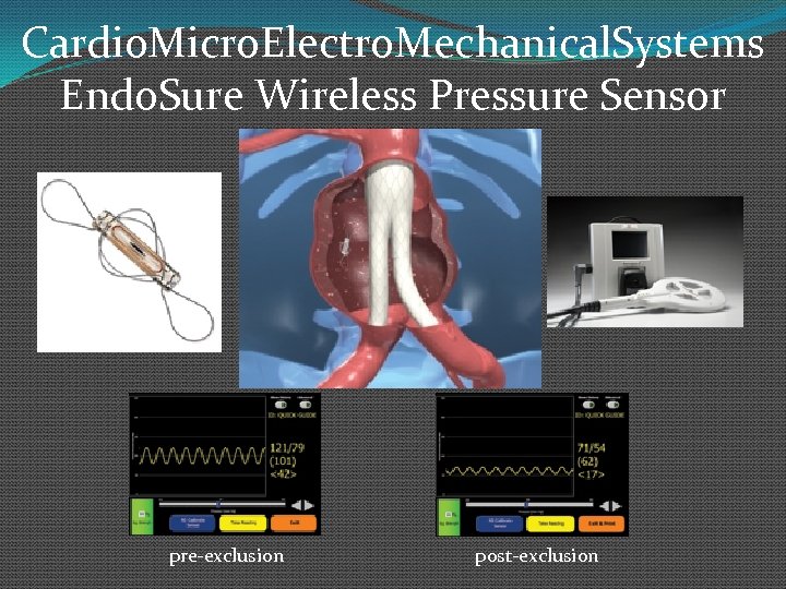 Cardio. Micro. Electro. Mechanical. Systems Endo. Sure Wireless Pressure Sensor pre-exclusion post-exclusion 