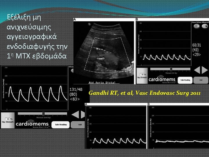 Εξέλιξη μη ανιχνεύσιμης αγγειογραφικά ενδοδιαφυγής την 1η ΜΤΧ εβδομάδα Gandhi RT, et al, Vasc