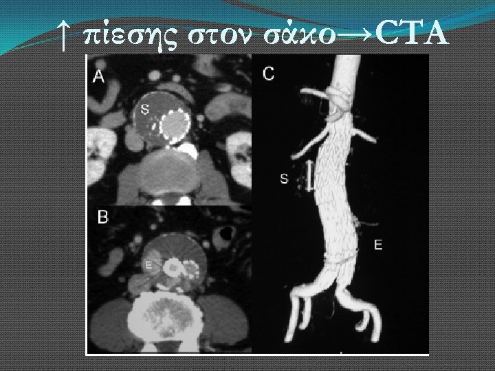 ↑ πίεσης στον σάκο→CTA 