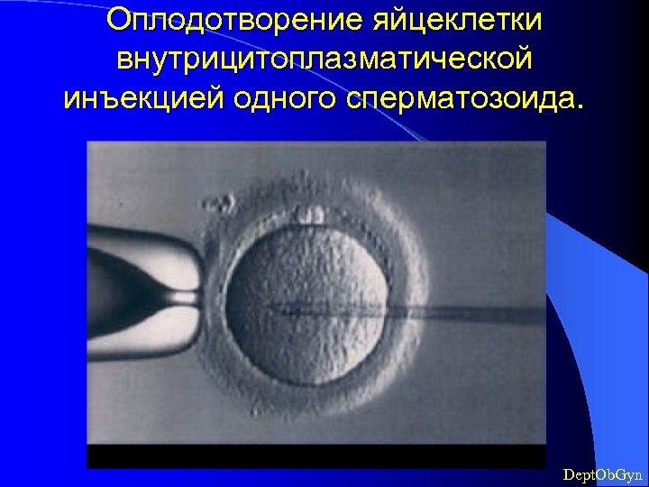 Оплодотворение яйцеклетки внутрицитоплазматической инъекцией одного сперматозоида. Dept. Ob. Gyn 