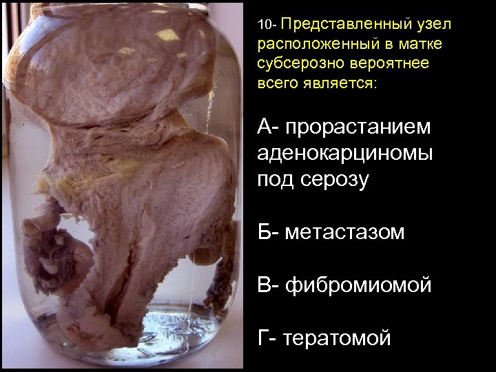 10 - Представленный узел расположенный в матке субсерозно вероятнее всего является: А- прорастанием аденокарциномы