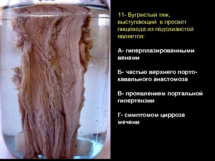 11 - Бугристый тяж, выступающий в просвет пищевода из подслизистой является: А- гиперплазированными венами