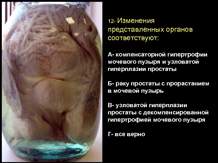 12 - Изменения представленных органов соответствуют: А- компенсаторной гипертрофии мочевого пузыря и узловатой гиперплазии