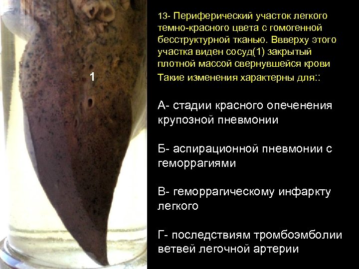 13 - Периферический участок легкого 1 темно-красного цвета с гомогенной бесструктурной тканью. Ввверху этого