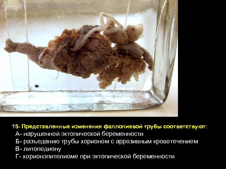 15 - Представленные изменения фаллопиевой трубы соответствуют: А- нарушенной эктопической беременности Б- разъеданию трубы