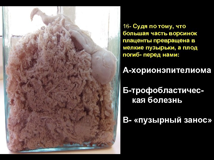 16 - Судя по тому, что большая часть ворсинок плаценты превращена в мелкие пузырьки,