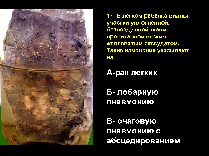 17 - В легком ребенка видны участки уплотненной, безвоздушной ткани, пропитанной вязким желтоватым экссудатом.