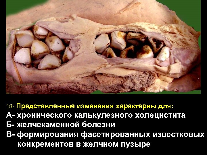 18 - Представленные изменения характерны для: А- хронического калькулезного холецистита Б- желчекаменной болезни В-
