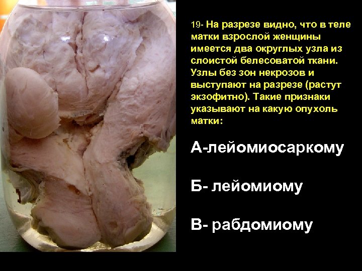 19 - На разрезе видно, что в теле матки взрослой женщины имеется два округлых