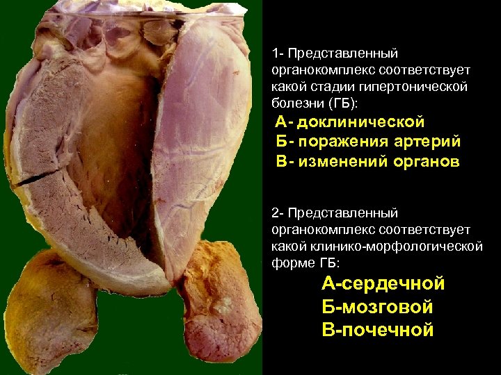 1 - Представленный органокомплекс соответствует какой стадии гипертонической болезни (ГБ): А- доклинической Б- поражения