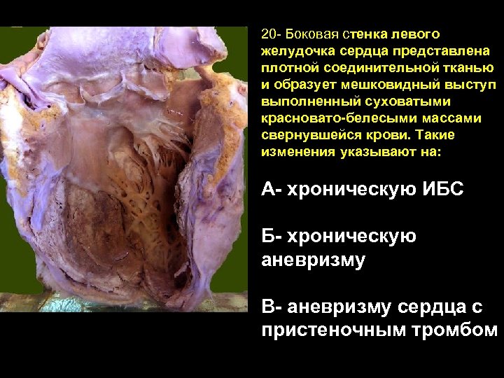 20 - Боковая стенка левого желудочка сердца представлена плотной соединительной тканью и образует мешковидный