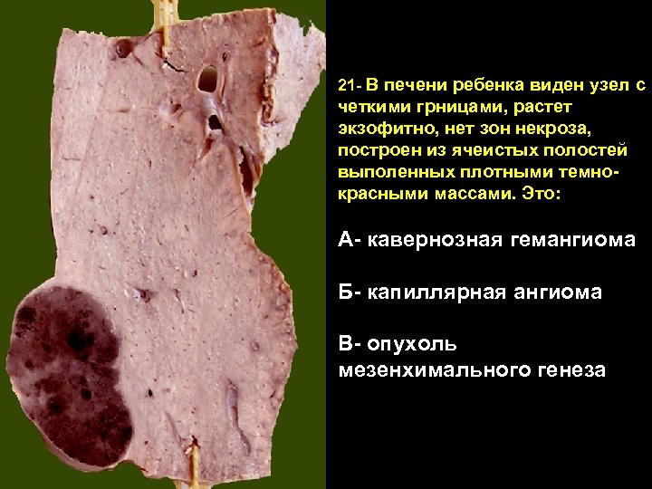 21 - В печени ребенка виден узел с четкими грницами, растет экзофитно, нет зон