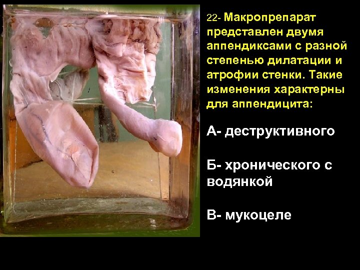22 - Макропрепарат представлен двумя аппендиксами с разной степенью дилатации и атрофии стенки. Такие