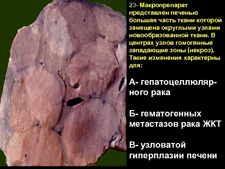 23 - Макропрепарат представлен печенью большая часть ткани которой замещена округлыми узлами новообразованной ткани.