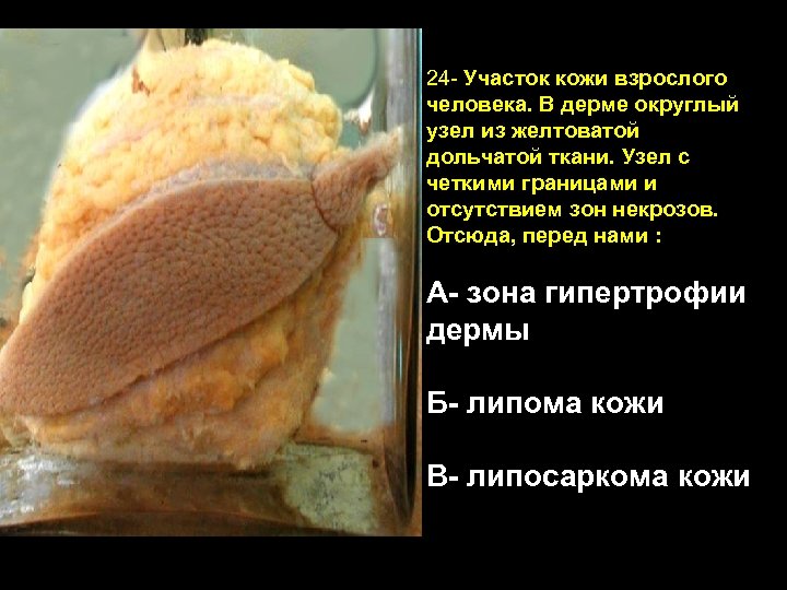 24 - Участок кожи взрослого человека. В дерме округлый узел из желтоватой дольчатой ткани.
