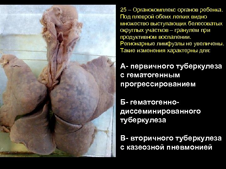 25 – Органокомплекс органов ребенка. Под плеврой обеих легких видно множество выступающих белесоватых округлых