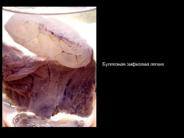 Буллезная эмфизема легких 