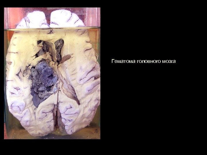 Гематома головного мозга 