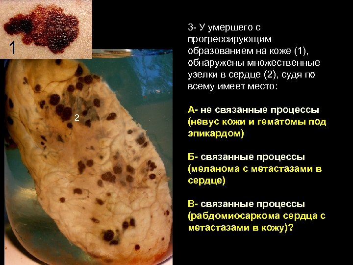 3 - У умершего с прогрессирующим образованием на коже (1), обнаружены множественные узелки в