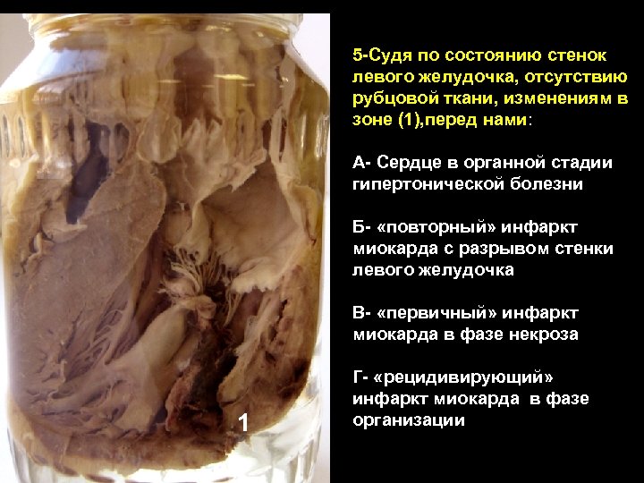 5 -Судя по состоянию стенок левого желудочка, отсутствию рубцовой ткани, изменениям в зоне (1),