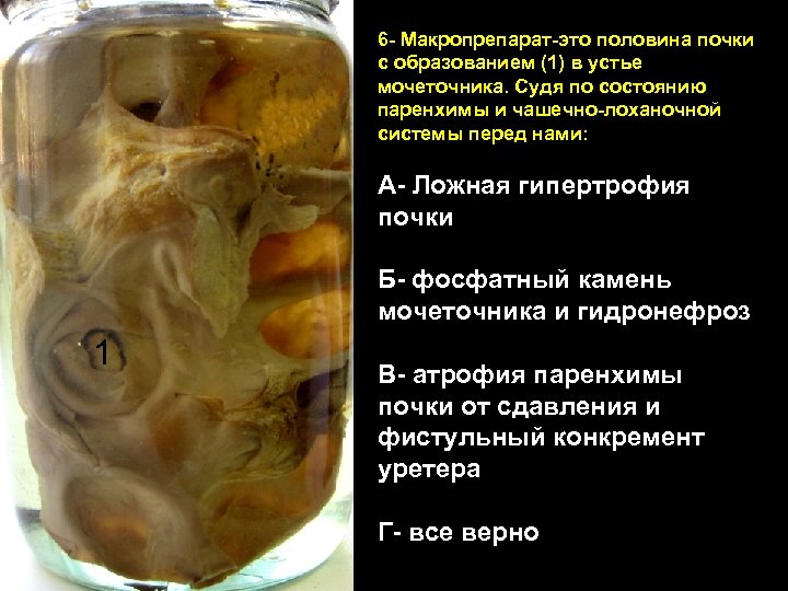 6 - Макропрепарат-это половина почки с образованием (1) в устье мочеточника. Судя по состоянию