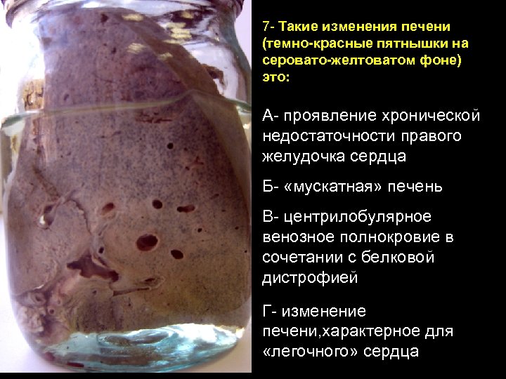 7 - Такие изменения печени (темно-красные пятнышки на серовато-желтоватом фоне) это: А- проявление хронической